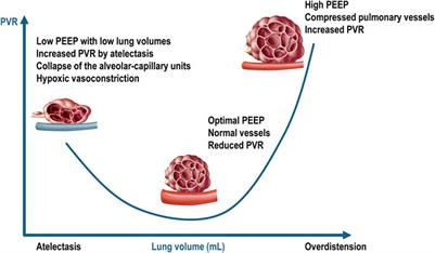 Heart-lung crosstalk in acute respiratory distress syndrome